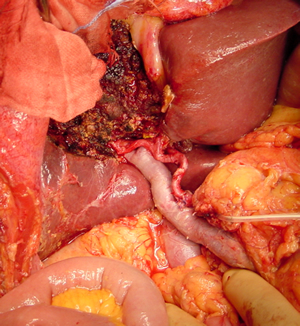 胆のう癌手術 肝切除と膵頭十二指腸切除を併せて行った症例（切除後の写真）